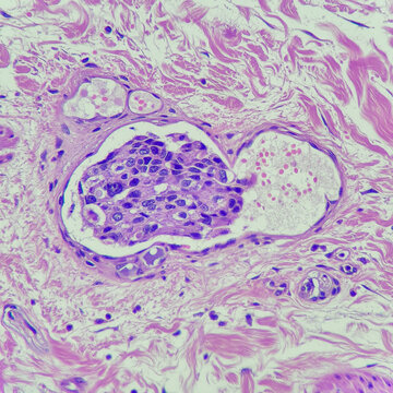 Camera photo of breast carcinoma with lymphovascular invasion, magnification 400x, photograph through a microscope