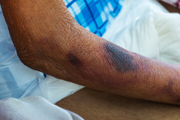 Blood bruises under the skin of an elderly patient