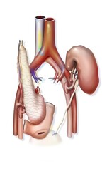 Combined pancreas and kidney transplant: implantation of grafts.