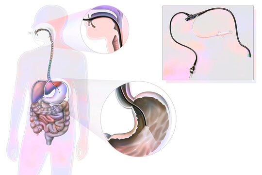 Gastroscopy: route and location of the gastro fiberscope introduced.