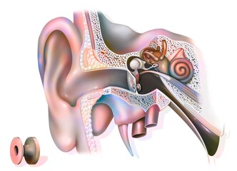 Otitis treatment: tympanic ventilator in the ear to promote. - obrazy, fototapety, plakaty