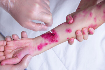 The skin rash in a child is treated with a cotton swab. Chickenpox virus. Skin rash and blisters on...