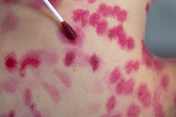 The skin rash in a child is treated with a cotton swab. Chickenpox virus. Skin rash and blisters on...