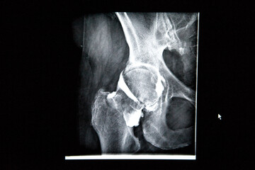 In a radiology center an x-ray of the hip with osteoarthritis.