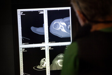 In a radiology center a radiologist observes scans of the shoulder.