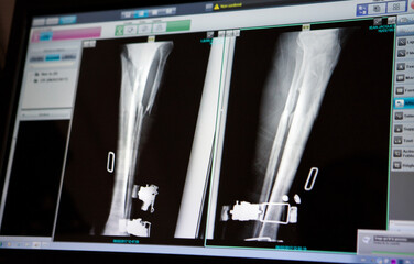 X-ray of the leg of a patient had a ski fall with a fractured tibia.