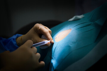 Anesthesia for removal of a cyst in a dermatology practice. - obrazy, fototapety, plakaty