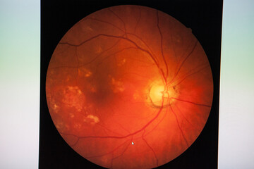 Fundus: routine examination established by an ophthalmoscope to check.