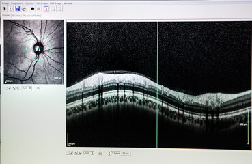 Optical coherence tomography (OCT) showing the optic nerve.