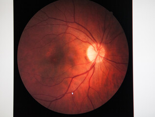 Fundus of a patient with macular edema.