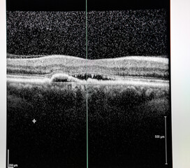 Optical coherence tomography (OCT) of a patient with macular edema.