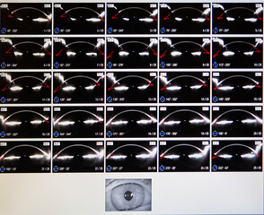 Corneal sections: Imaging obtained by corneal topographer.