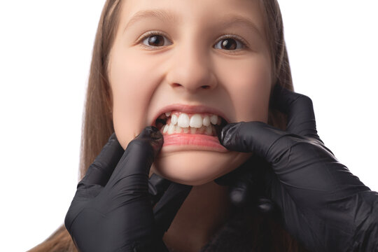 A doctor in black medical gloves examines the oral cavity of a little cute girl. Crooked teeth. Studio photo on a white background.