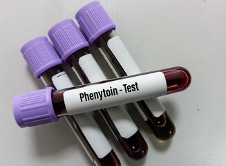 Blood sample for Phenytoin test, therapeutic drug, to maintain a therapeutic level and diagnose...