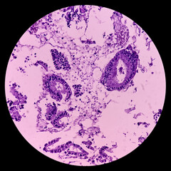 Endocervical tissue biopsy: Photomicrograph show part of ectocervix and few fragmented endocervical...