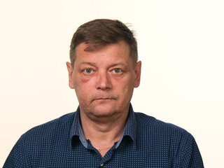 Obraz premium close-up portrait of a 50-year-old man with a swollen cheek and a black eye