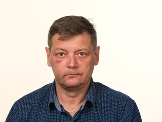 close-up portrait of a 50-year-old man with a swollen cheek and a black eye