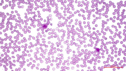 Light micrograph showing human blood cells (Blood smear). Erythrocytes  make up the majority of blood cells.  Two types of white blood cell (purple) - neutrophil and lymphocyt.   Magnification: x600.
