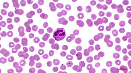 Light micrograph showing human blood cells. Erythrocytes are pink. They make up the majority of blood cells.  Also in the center you can see a large cell with a nucleus (neutrophil). 