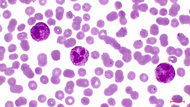 Light micrograph of human blood cells, showing numerous red cells (erythrocytes) and three neutrophils (white cells) with segmented nucleus. © BioFoto