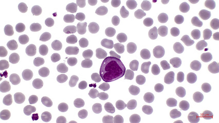 A smear of human blood under a microscope. In the center among erythrocytes is a large cell with a...