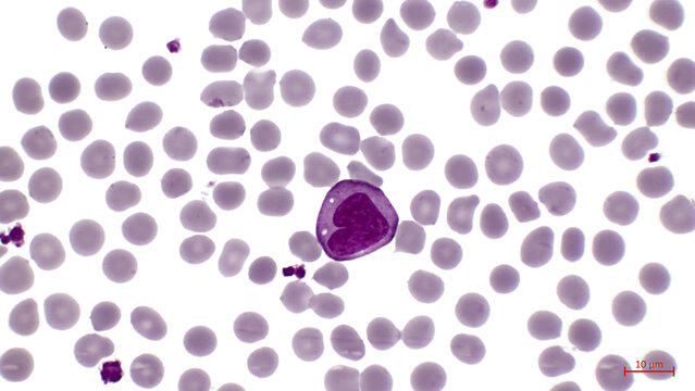 A smear of human blood under a microscope. In the center among erythrocytes is a large cell with a bean shaped nucleus - a monocyte. Monocytes in the circulation are precursors of tissue macrophages.