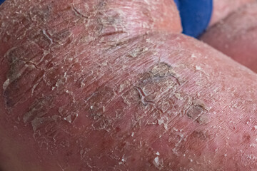 Fototapeta premium Closeup of cracked and dry skin disease. Medical healthcare concept. Cosmetology dermatology concept.