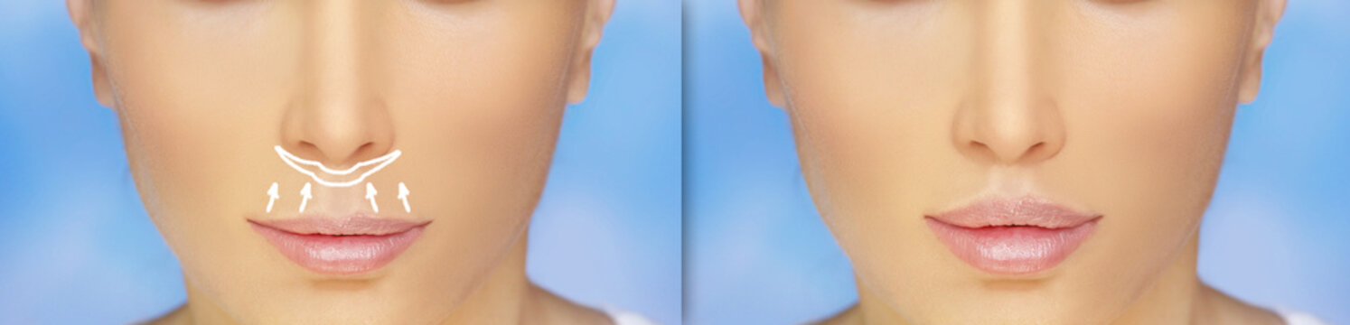 lip lift surgery,bullhorn technique, plastic surgery concept.