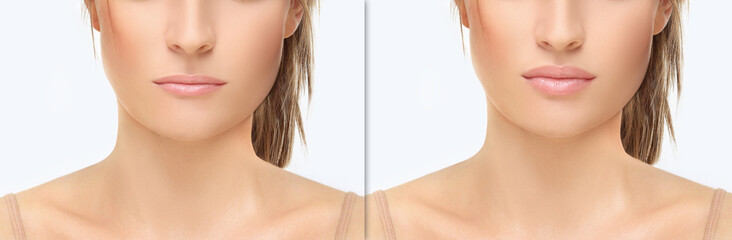 Obraz na płótnie Canvas Beauty injections.Concept of rejuvenation.Lip augmentation