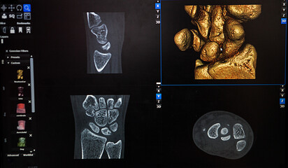 3D reconstruction from a CT image of a patient's wrist.