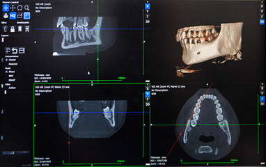 3D reconstruction from a CT image of a patient's jaw for personalized. © RFBSIP