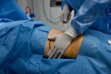 Cosmetic surgery liposuction aspiration of fat by a pump.