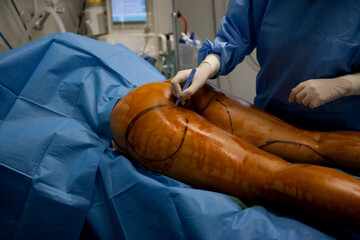 Cosmetic surgery liposuction aspiration of fat by a pump.