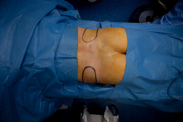 Cosmetic surgery: liposuction operation on the waist.