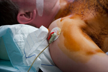 Monitoring during liposuction in a man.