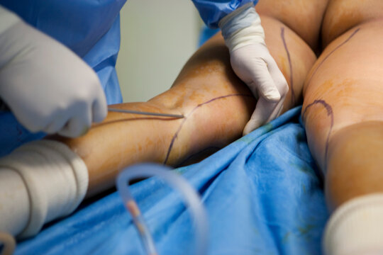 Cosmetic surgery liposuction aspiration of fat by a pump.