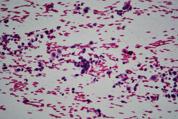 Microscopic image of ovarian tumor. Serous papillary cancer