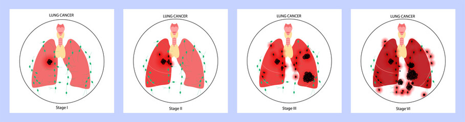 Lungs cancer disease