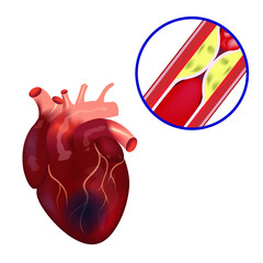 Coronary artery disease. Disease infographic. Atherosclerosis of the vessels. Medical vector illustration - obrazy, fototapety, plakaty