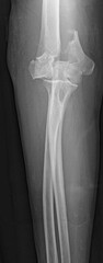 An x-ray image of  supracondylar humerus  fracture  
