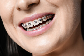 Smiling woman with dental braces, closeup