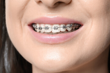 Smiling woman with dental braces, closeup