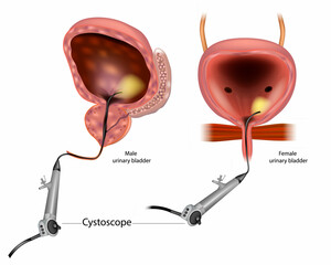Diagram showing a Flexible cystoscopy for a man and a woman. Anatomy Male and Female Urinary Bladder. Flexible Cystoscopy - Procedure for Visually Inspecting Bladder and Urethra