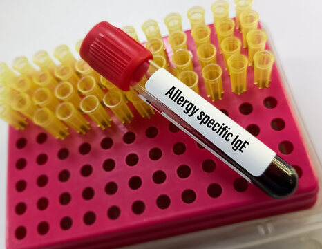 Blood sample for Allergy specific IgE test. Allergy testing for detect allergen substance cause allergic reaction by measure IgE antibodies.