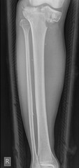 Tibial plateau fractures are break  in the upper part of the shinbone (tibia) frequently associated with soft tissue injury.