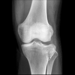 Tibial plateau fractures are break in the upper part of the shinbone (tibia) frequently associated...
