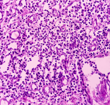 Kidney(biopsy): Chronic pyelonephritis, show areas of thyroidization and infiltration of inflammatory cells in the renal parenchyma.