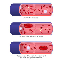 Thrombosis. Deep vein thrombosis(DVT). Embolism.