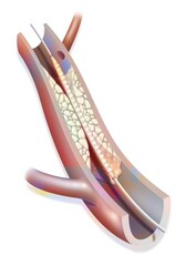 Angioplasty (stenting) helps restore blood flow to an artery blocked.