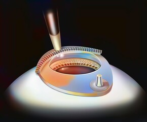 Eye surgery Lasik step 1: the microrobot is guided by a suction ring. - obrazy, fototapety, plakaty